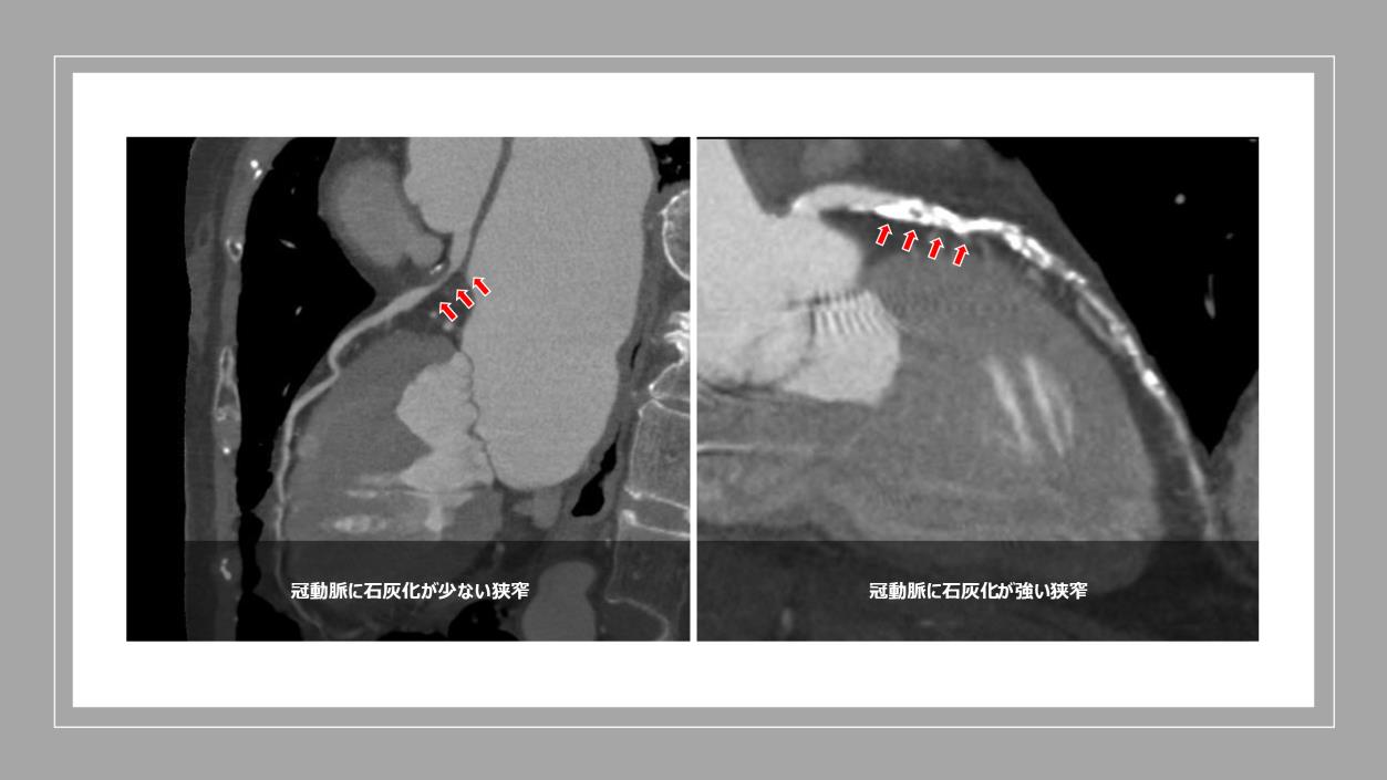 冠動脈石灰化の原因